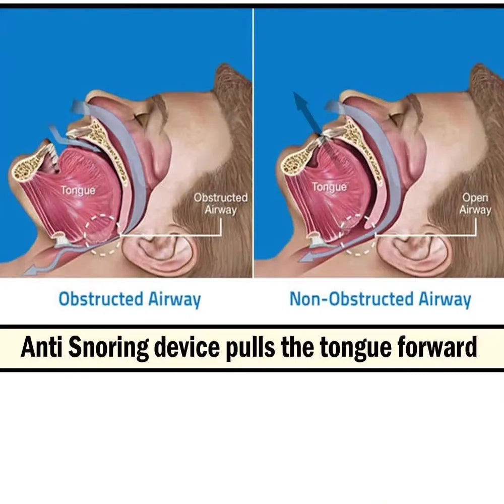 Anti-Snoring Silicone Tongue Retainer